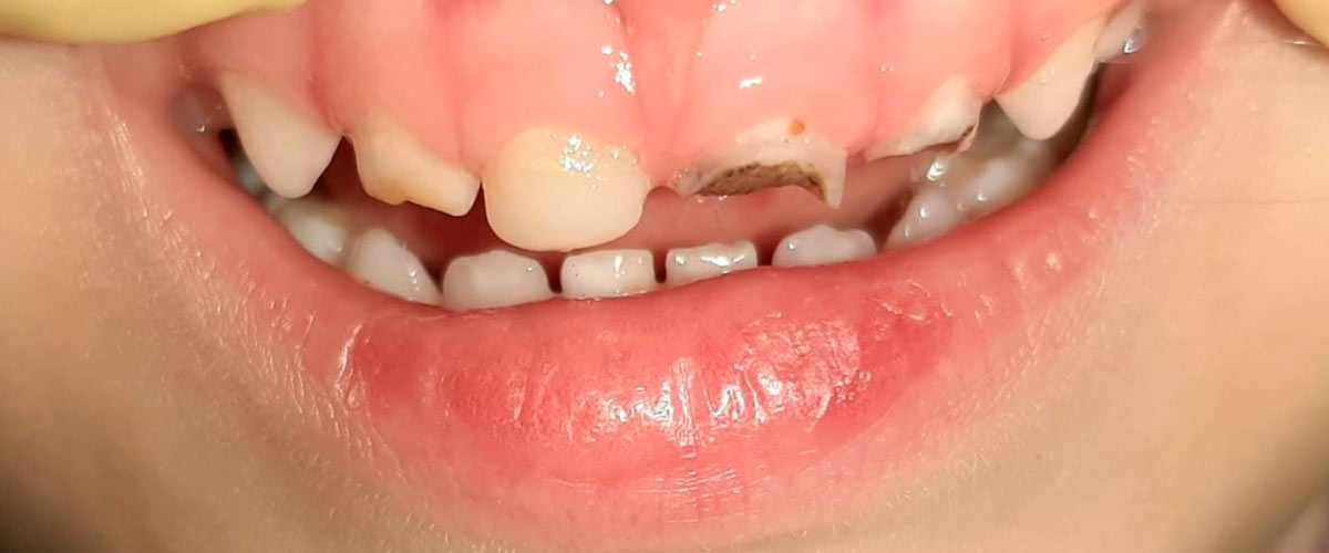 Слайдер Лечение зубов на аппарате Рондофлекс