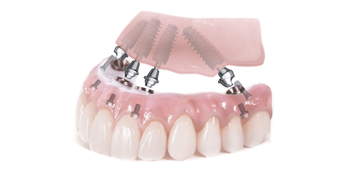 Имплантация зубов All-on-4 во Всеволожске