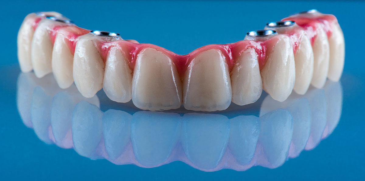 Зубные протезы на имплантантах